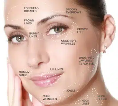 Woman's face with text identifying where Dysport can be used