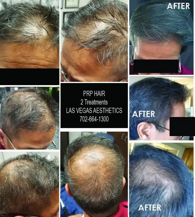 Picture of men's heads depicting before and after hair restoration