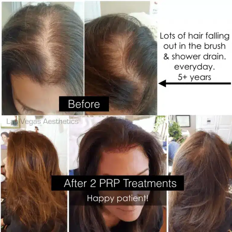 Picture of women's heads depicting before and after hair restoration