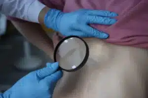 Stretch Marks