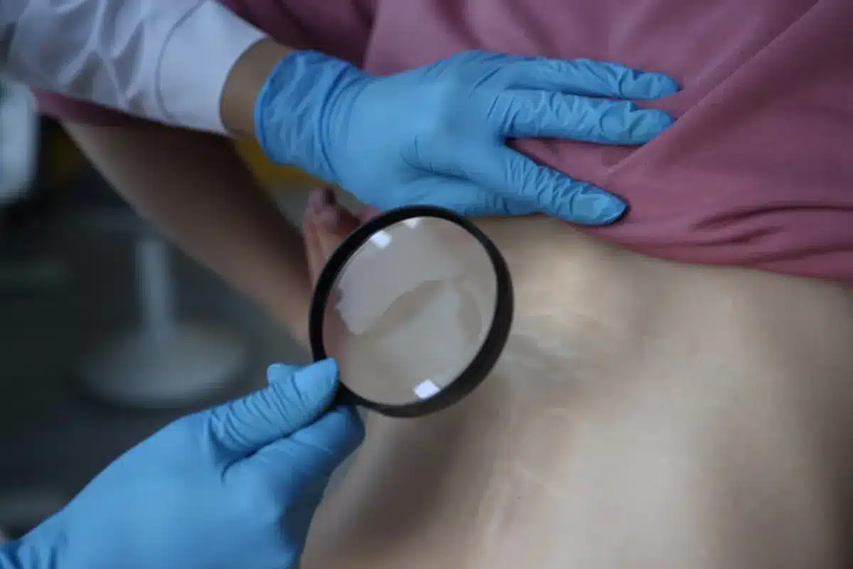 Read more about the article Stretch Marks