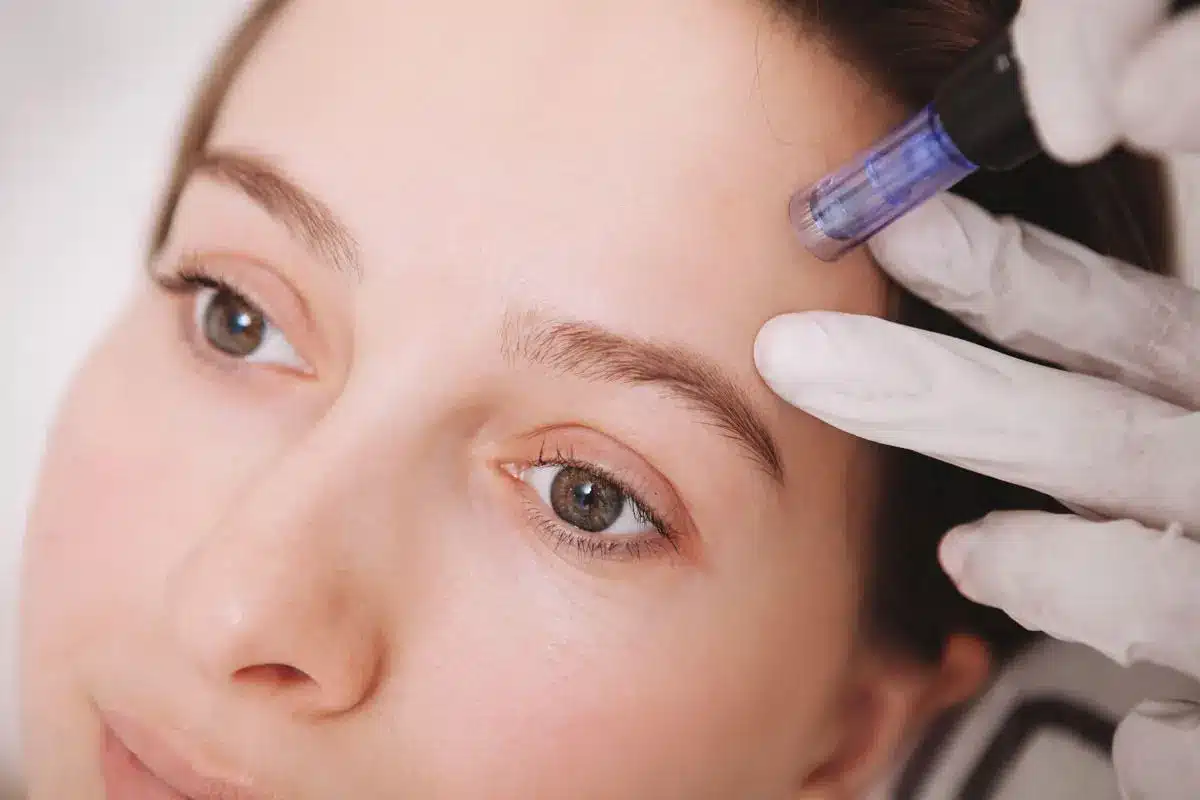 Read more about the article Vampire Facial® / Micro-Needling