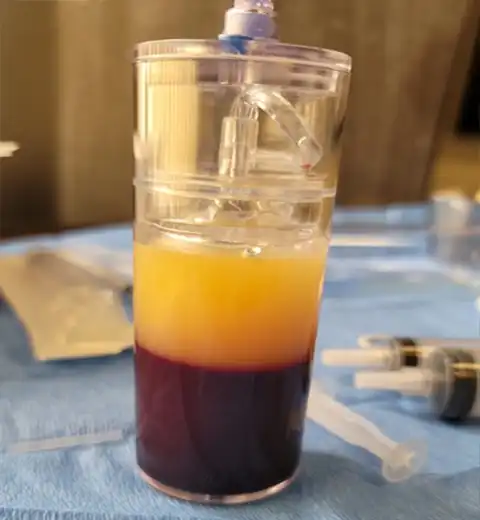Centrifuged PRP showing golden plasma layer over red blood cells on sterile treatment tray — Vampire Facelift preparation at Las Vegas Aesthetics