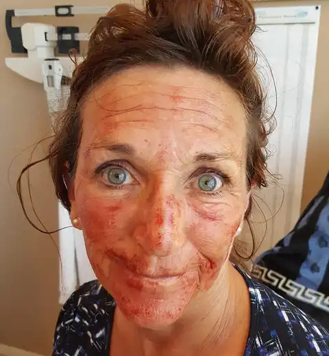 Centrifuged PRP showing golden plasma layer over red blood cells on sterile treatment tray — Vampire Facelift preparation at Las Vegas Aesthetics