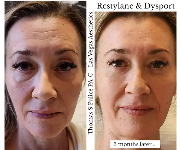 Restylane and Dysport before and after Las Vegas — 6 months later showing reduced forehead lines and improved facial volume at Las Vegas Aesthetics by Thomas Pulice PA-C