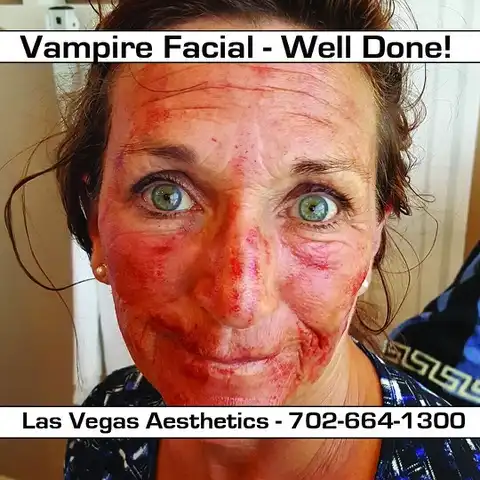Patient immediately following Vampire Facial® with PRF microneedling at Las Vegas Aesthetics — showing typical post-treatment redness and PRP application by Thomas S. Pulice, PA-C