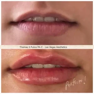 Restylane lip filler close-up before and after Las Vegas — natural lip volume and definition results at Las Vegas Aesthetics by Thomas Pulice PA-C