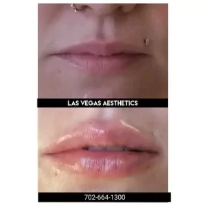 Restylane lip filler before and after Las Vegas — natural lip volume and fullness results at Las Vegas Aesthetics by Thomas Pulice PA-C